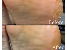 カシェット 広島店(Cachette)/50代女性☆足裏角質ケア90分