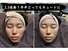 セントラル鍼灸院リラクシー(Re:laxy)/パルス美容鍼継続でこんなに驚愕