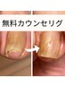 【巻き爪・変形爪】まずは電話で無料カウンセリング♪0円