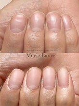 マリーロール 梅田店(Marie Laure)/自爪育成/深爪矯正/ネイルケア