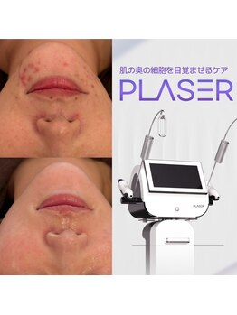ルミライズ(Lumirise)の写真/当店人気Ｎo.2★エステで極稀少！本格的な【エステ版ポテンツァ】★深層部からお悩みを根本改善！