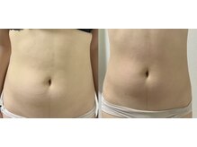 エヌ(N)の雰囲気（１回目の施術でお腹の下腹のぽっこりが軽減されました。）