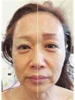 ラヴィアンローズ(LavieenRose)/πセラピー小顔矯正術の効果