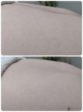 エステシェービングサロン フルール(Fleur)/背中のシェービング