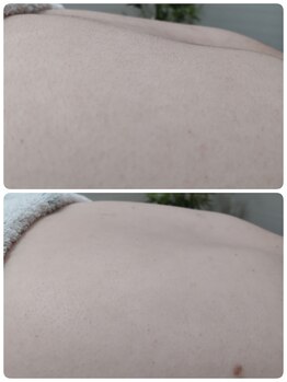 エステシェービングサロン フルール(Fleur)/背中のシェービング