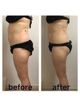 ベルフィーヌ 北千住店(BELFINE)/ボディ超音波ビフォーアフター