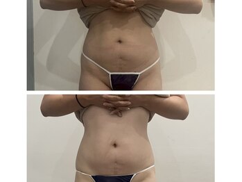 ココ 茅ヶ崎店(Coco)/マイクロウェーブリフト