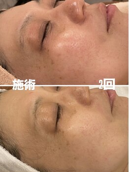 トータルエステティック ジョワイユ(JOYEUX)/施術2回での効果！！