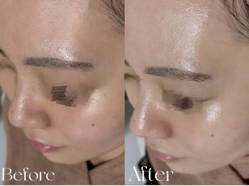 ウィハナ(wehana)/【ララピール】赤み/ニキビ