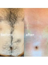 ブラジリアンワックス&光脱毛サロン　　　　　　No.A 恵比寿店【ナンバーエー】/"お腹ダブル脱毛"