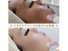 レゾン 京橋店の雰囲気（《完全個室で施術》当店一番人気のニキビケアコースで透明感UP☆）