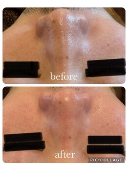 オゾンレメディ(O3remedy)/毛穴洗浄