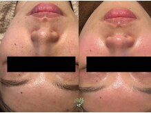 フラーブ(Flourb)/ハーブピーリング｜症例写真