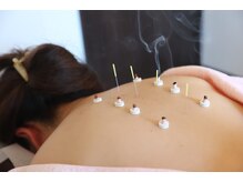 ねこの手/背中のお灸と鍼