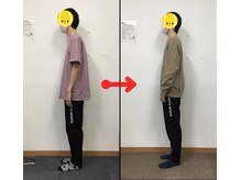 なぎ整体院/猫背矯正ビフォーアフター