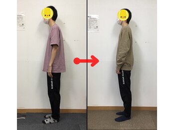 なぎ整体院/猫背矯正ビフォーアフター