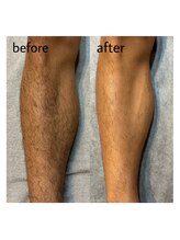ヴィシアス(VIXIAS)/脱毛　施術1回　2ヶ月後