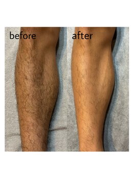 ヴィシアス(VIXIAS)/脱毛　施術1回　2ヶ月後