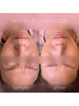 WA ネイル アンド ビューティー(WA nail & beauty)/ホワイトスノーピール2回