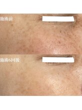 サロンドベルム(Salon de BELME)/シミケア経過：施術6回後