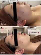 エミット(emit.)/脂肪燃焼剤導入＆小顔矯正