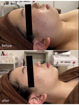 エミット(emit.)/脂肪燃焼剤導入＆小顔矯正