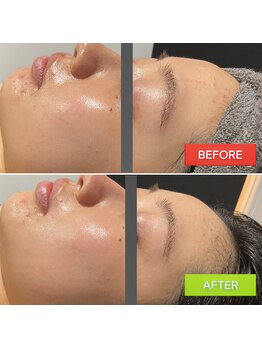 ホイップスパ(WHIP SPA)/毛穴洗浄【1度の効果】