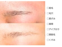 ピュアノア 三木店/脱毛　三木/小野/西脇/加東/加西