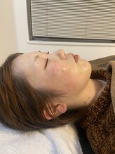 サロン ウェル(SALON WELL)/ 【ハーブピーリング 施術中】