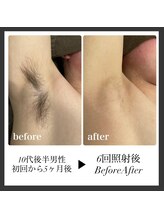 エリクサー 加須店(Elixir)/やはり6回で薄くなる！