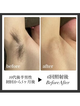 エリクサー 加須店(Elixir)/やはり6回で薄くなる！