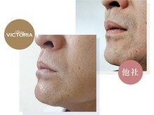 サロン ニヒル(SALON NIHIL)/◇男性髭脱毛◇