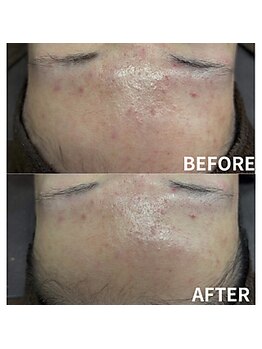 リノア(Linoa)/REVIVE ナチュラルハーブ