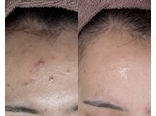 エヌ(N)/おでこニキビもハーブピーリング