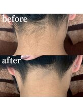 ミノア 大野城店(MINOA)/うなじ脱毛M型ビフォーアフター