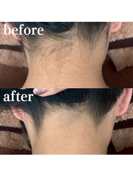 ミノア 大野城店(MINOA)/うなじ脱毛M型ビフォーアフター