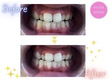 エクシアホワイトニング 天王寺店/ホワイトニングビフォーアフター