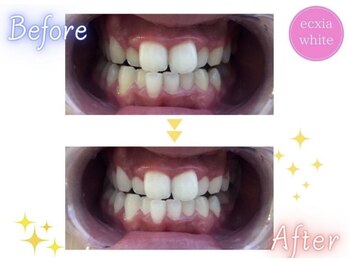 エクシアホワイトニング 天王寺店/ホワイトニングビフォーアフター