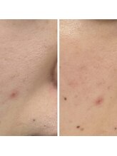 プレイス 堂山本店(PLACE)/ハーブピーリング