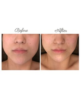 ウルエッテ(UluEtte)/フェイスラインすっきりと/福岡