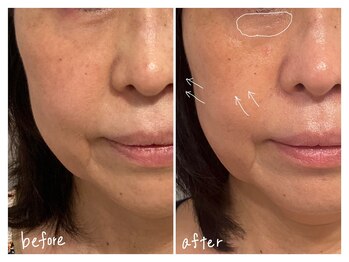 ミースプラス(me,as+)/高周波サーマ 全顔1回 (術直後)