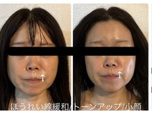 ビノスビューティー(vinos.beauty)/症例写小顔矯正　ほうれい線緩和