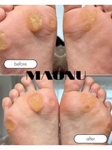 マオヌー(MAONU)/韓国式足裏角質ケア　症例写真