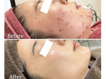 今まで何をしても結果が出なかった方！ニキビ研究が解決します！