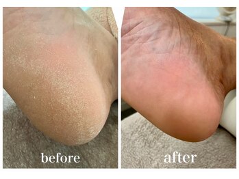 ラプラス(Laplace)/☆角質ケア☆