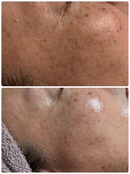 エルナ(ELUNA)/3か月肌改善プログラム 40代