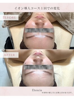 エレンシア(E'lencia)/施術効果（Before/After）