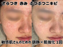 スキンラボアメリ(skin lab. ameri)の雰囲気(トロイアルケ|ざらつき赤ら顔ニキビケア|1回でこの変化)