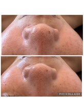 グランデ(Grande)/プラズマニアで毛穴ケア◎