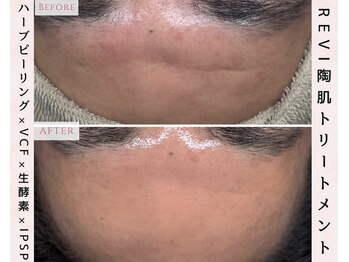 ルリエベル(Relier Belle)/REVIハーブピーリング